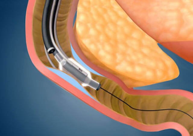 Revita® DMR (duodenal mucosal resurfacing) System close up procedure